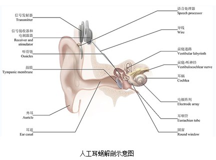 二,人工耳蜗的工作原理