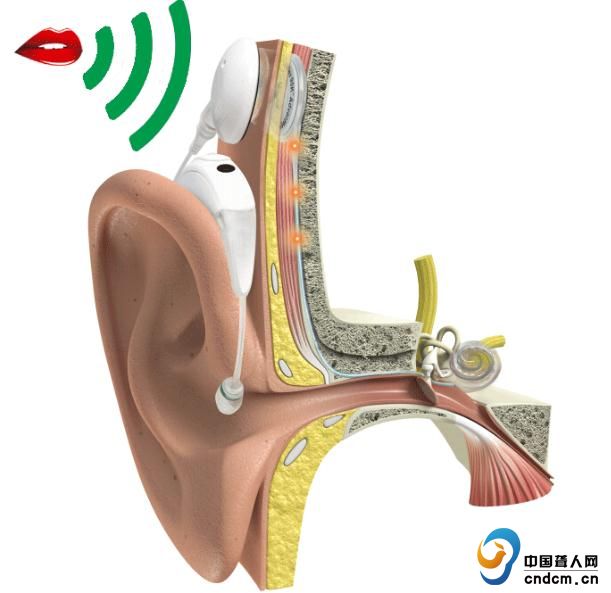 耳蜗知识 | 什么是人工耳蜗